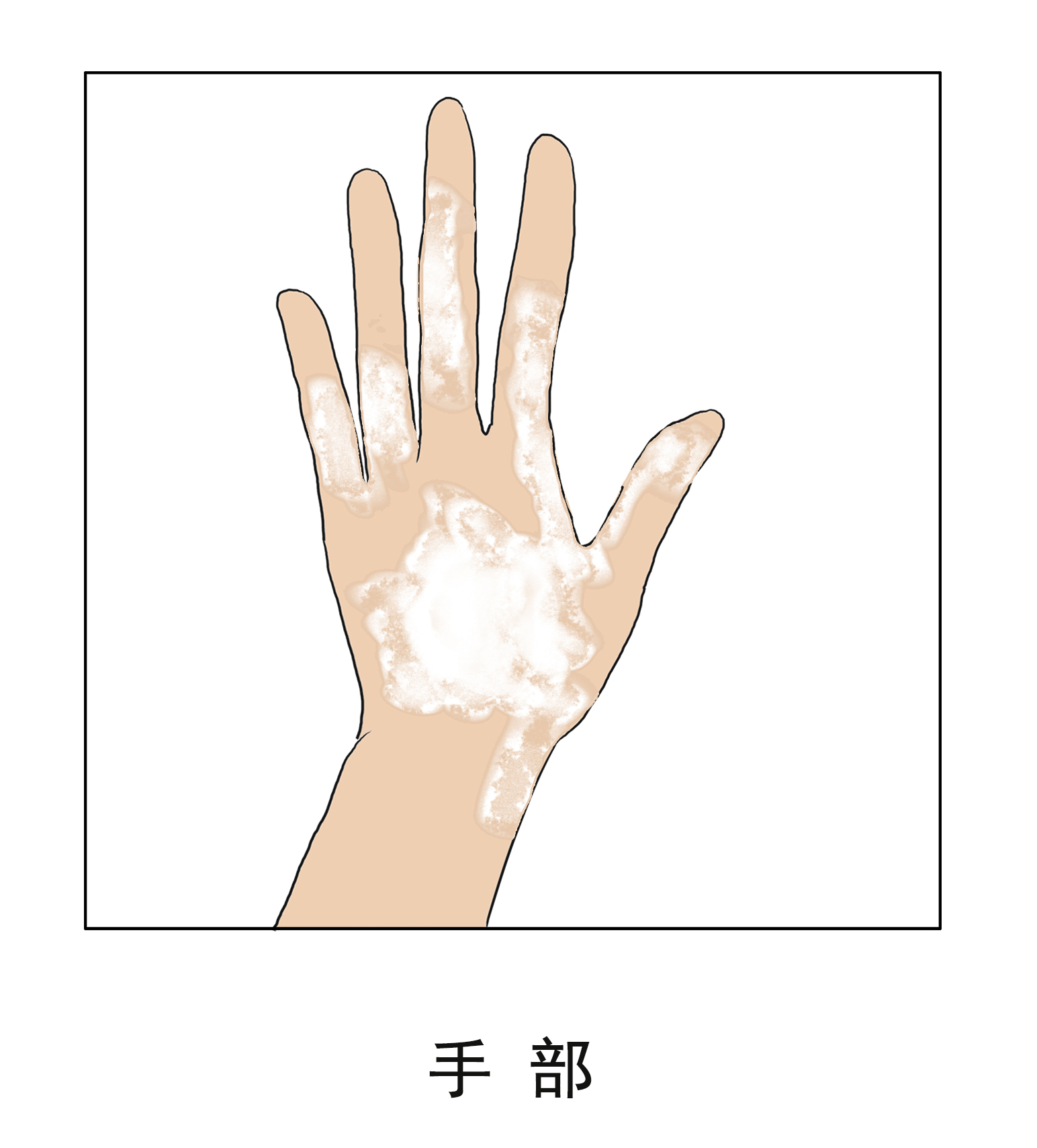 云南白斑病医院：注意手部白癜风的护理有什么措施